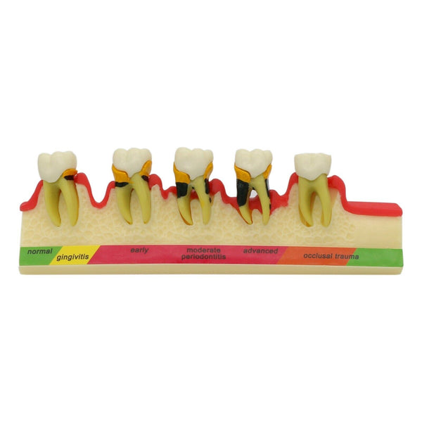 Dental Periodontal Disease Teeth Periodontics Study Model