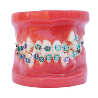 Dental Anatomy Orthodontic Treatment Study Model with Brackets