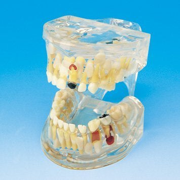 Dental Pathologies Anatomy Model vs Health Child