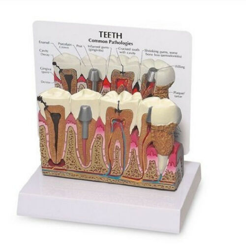 Dental Teeth and Gums Diseased Model Patient Education Teaching Model
