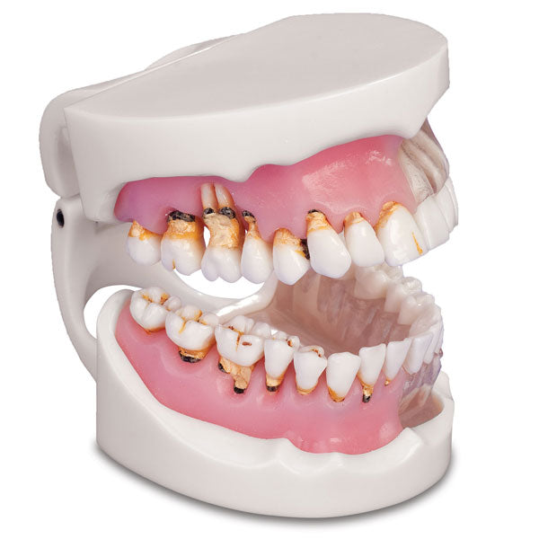 MDO DI Dental Pathological Gingivitis Demonstration Model Soft Gum