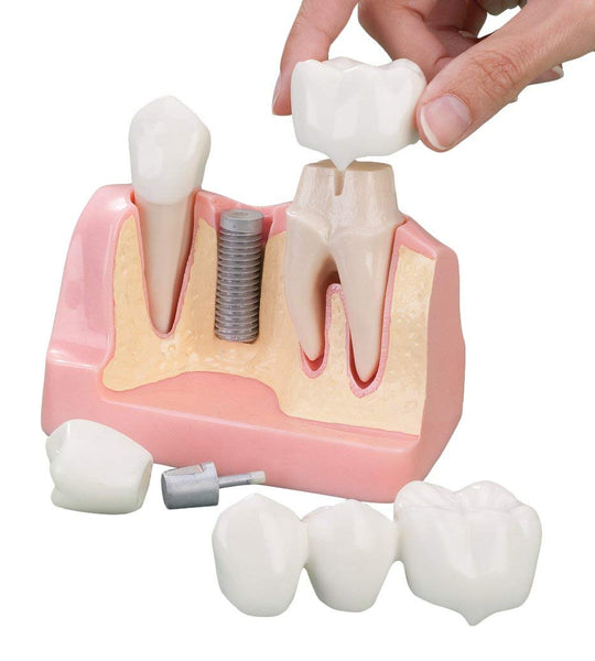Dental Implant/Prosthesis Reconstruction Analysis Model