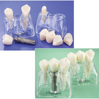Dental Implant-Bridge Comparison Set Educational Model