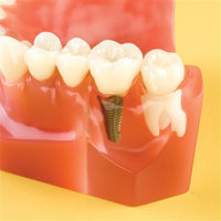 Dental Overdenture Demo 7-Unit Implant Practice Model