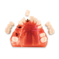 Dental Overdenture Demo 7-Unit Implant Practice Model