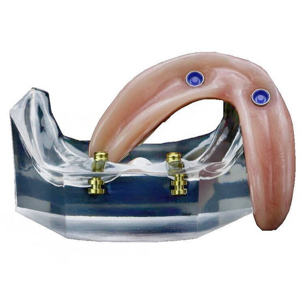 Lower Inferior Dental Model Overdenture 2 Implants Demo Model