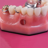 Dental Model Overdenture Implant Restoration Model CB-10