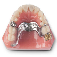 Dental Model Overdenture Implant Restoration Model