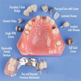 Dental Model Overdenture Implant Restoration Model CB-10