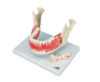 Dental Anatomy Disease Model (Lower Jaw)