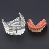 Dental Lower Inferior Teeth Model Overdenture 4 Implants Demo Model