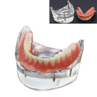 Dental Lower Inferior Teeth Model Overdenture 4 Implants Demo Model