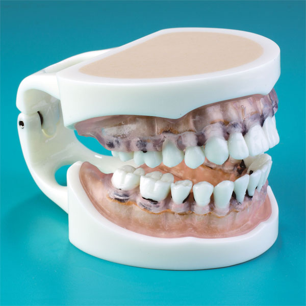 Dental Typodont MDO DI Bone Furcation Educational Model
