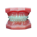 Dental Orthodontic Treatment Model (Metallic/Ceramic) Brackets