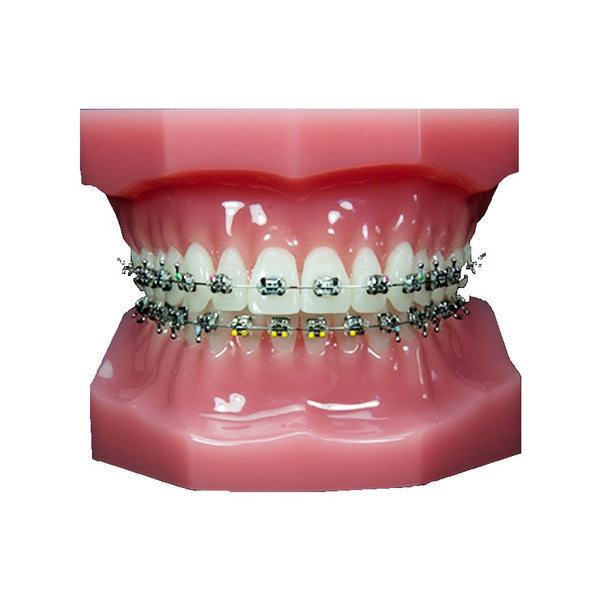 Traditional Braces - Smiles by German Design
