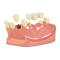 Dental Typodont Oversized Quadrant 3-Unit Bridge Model