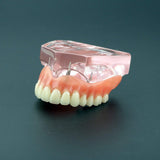 Dental Model Overdenture Superior with 4 Implants Demo Model Pink