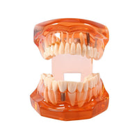 Removable Dental Implant Disease Teeth Restoration Bridge Teaching Model