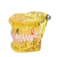 Removable Dental Implant Disease Teeth Restoration Bridge Teaching Model