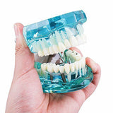 Dental Implant Disease Teeth Restoration Bridge Teaching Model